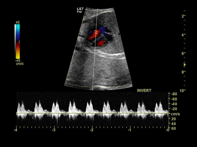 GE Logiq S7 с XDClear